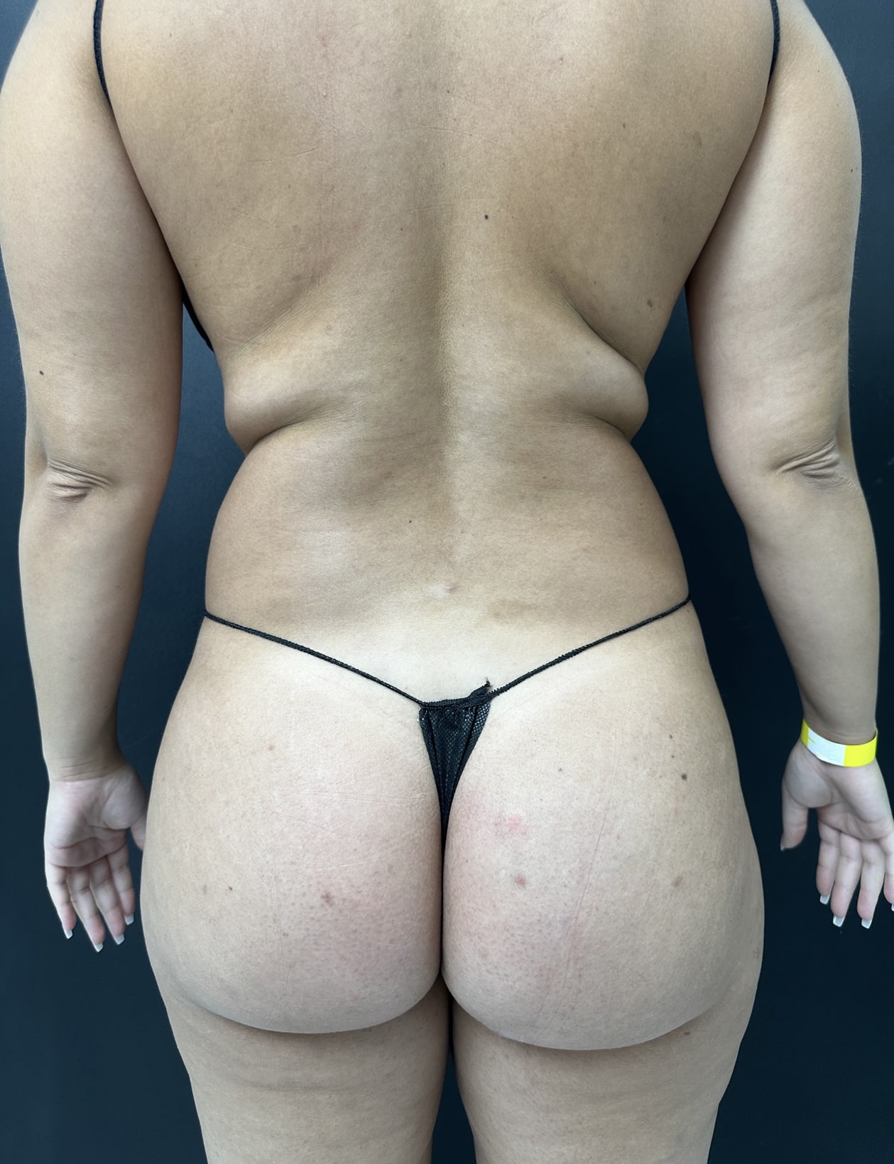 Before Image: BBL - back