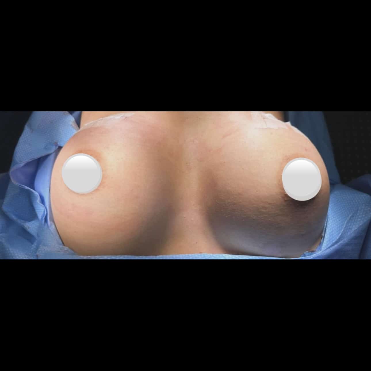 After Image: Breast Augmentation - front