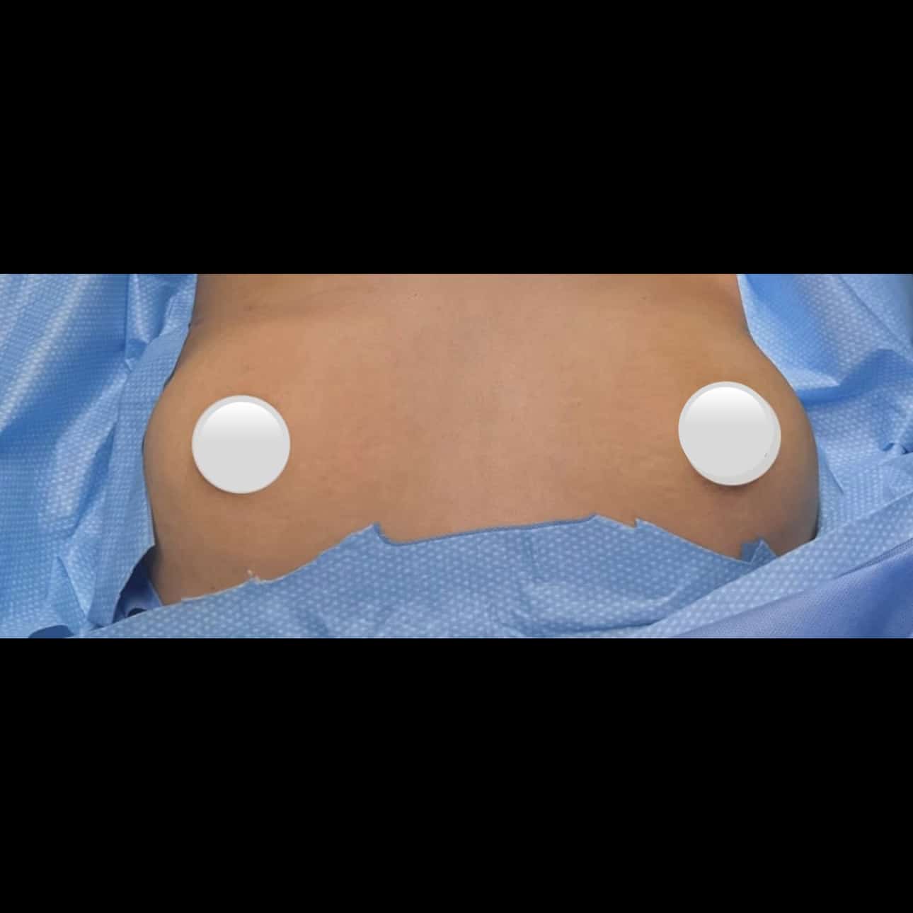 Before Image: Breast Augmentation - front