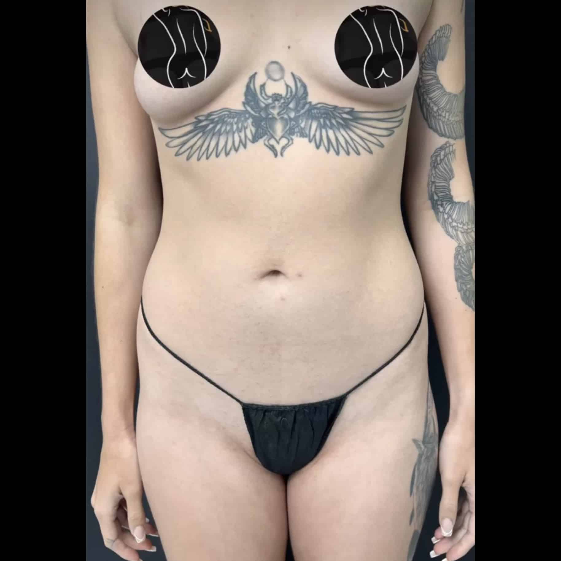 Before Image: BBL and Breast Augmentation - front