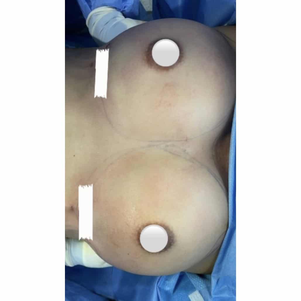 After Image: Breast Augmentation - front