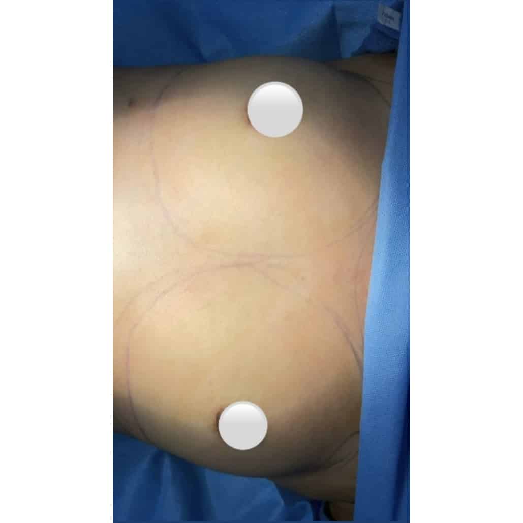 Before Image: Breast Augmentation - front