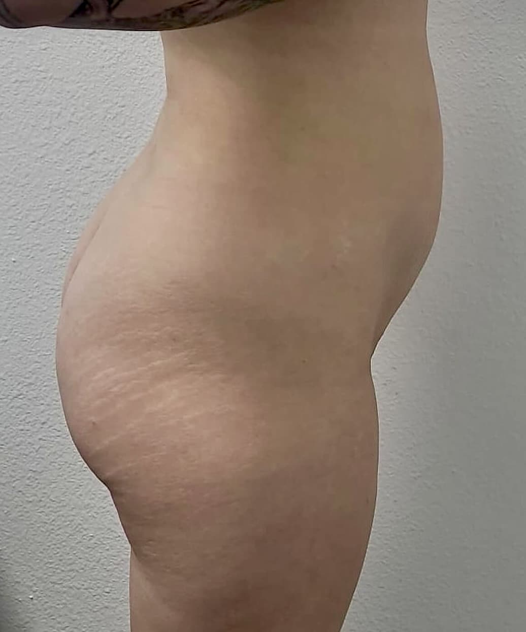 Before Image: BBL - right-side