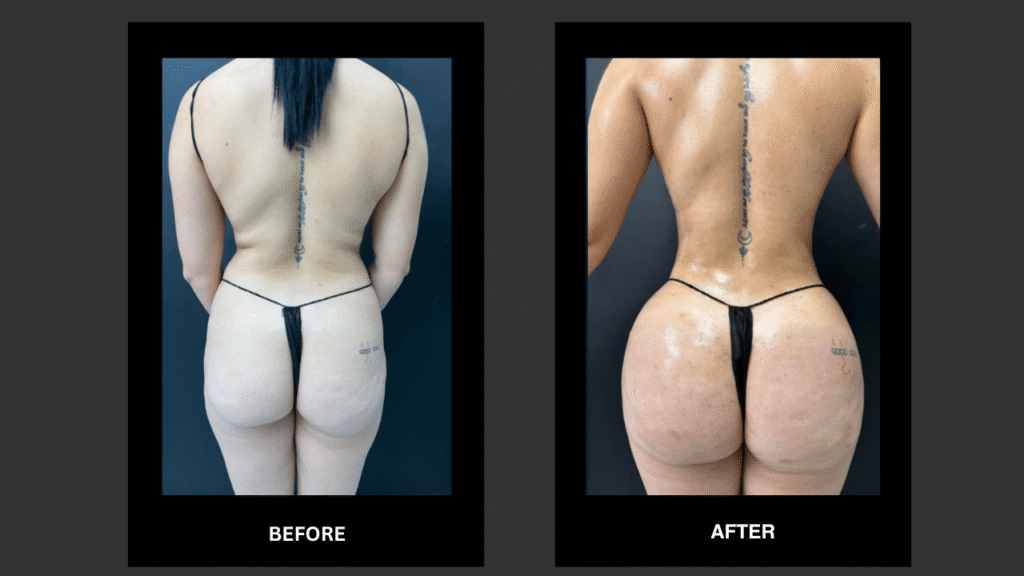 Radiesse (Injectable BBL) in Tampa, FL