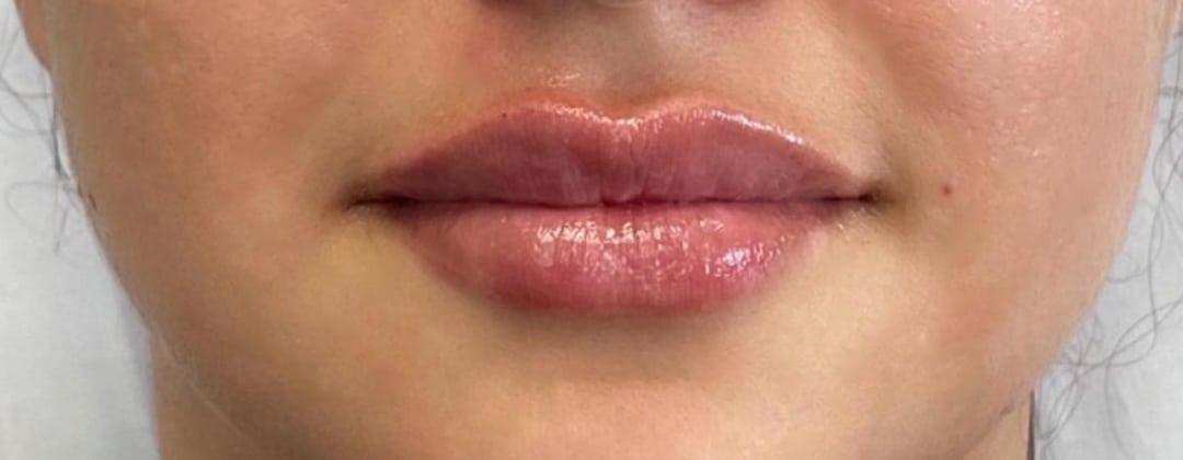 After Image: Non-Surgical Filler - front