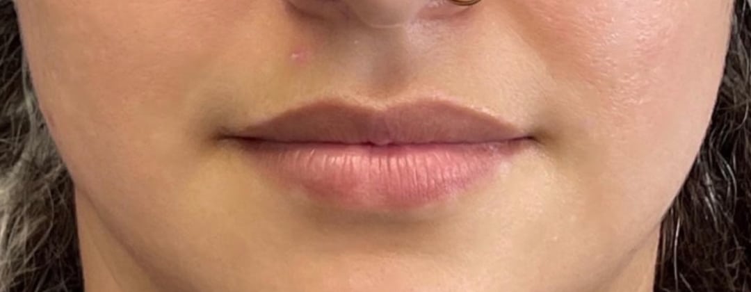 Before Image: Non-Surgical Filler - front