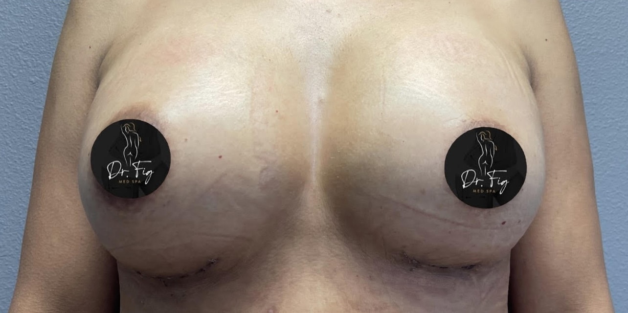 After Image: Breast Augmentation - front
