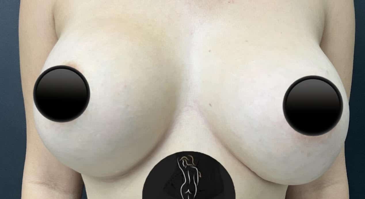Before Image: Breast Augmentation - front