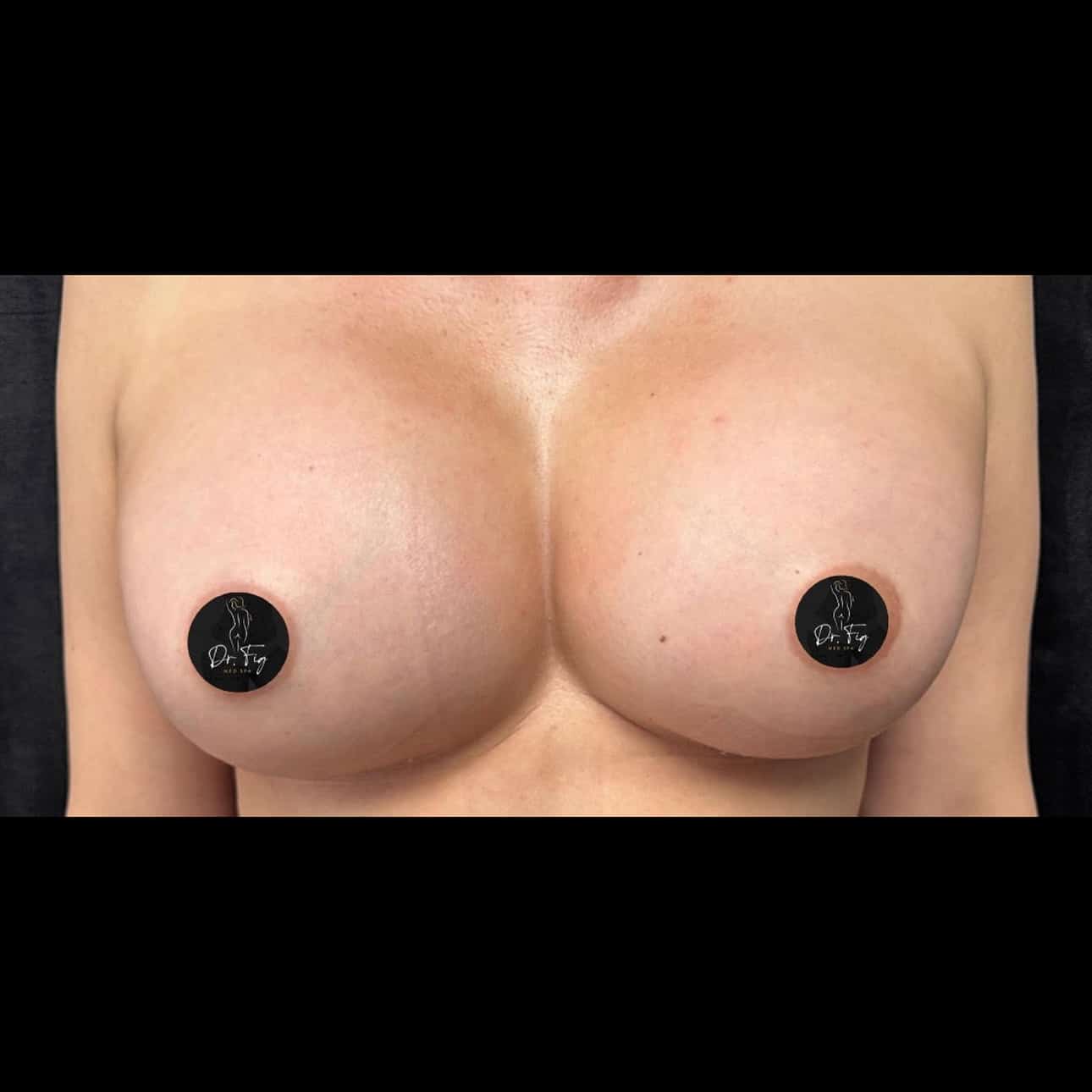 After Image: Breast Augmentation - front
