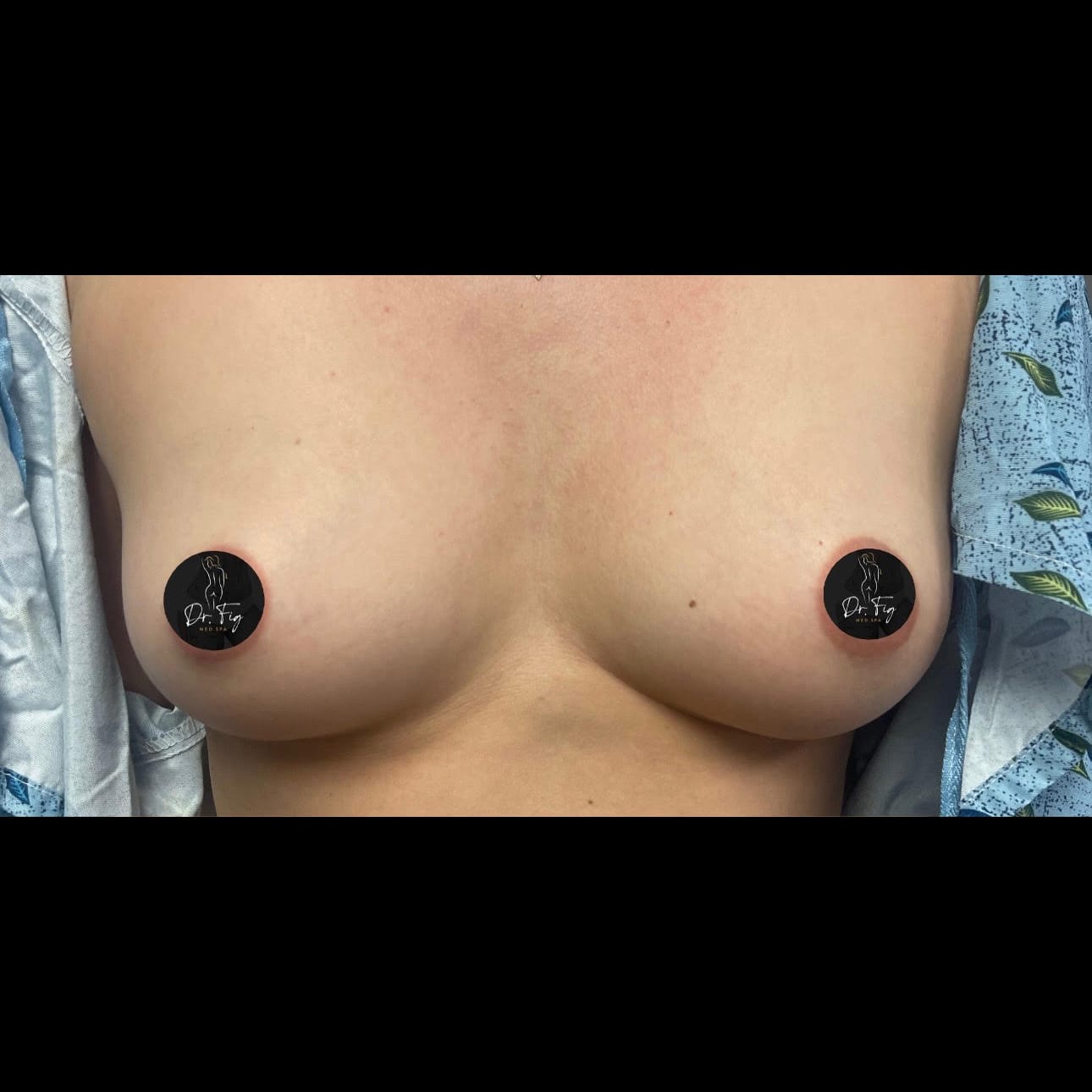 Before Image: Breast Augmentation - front