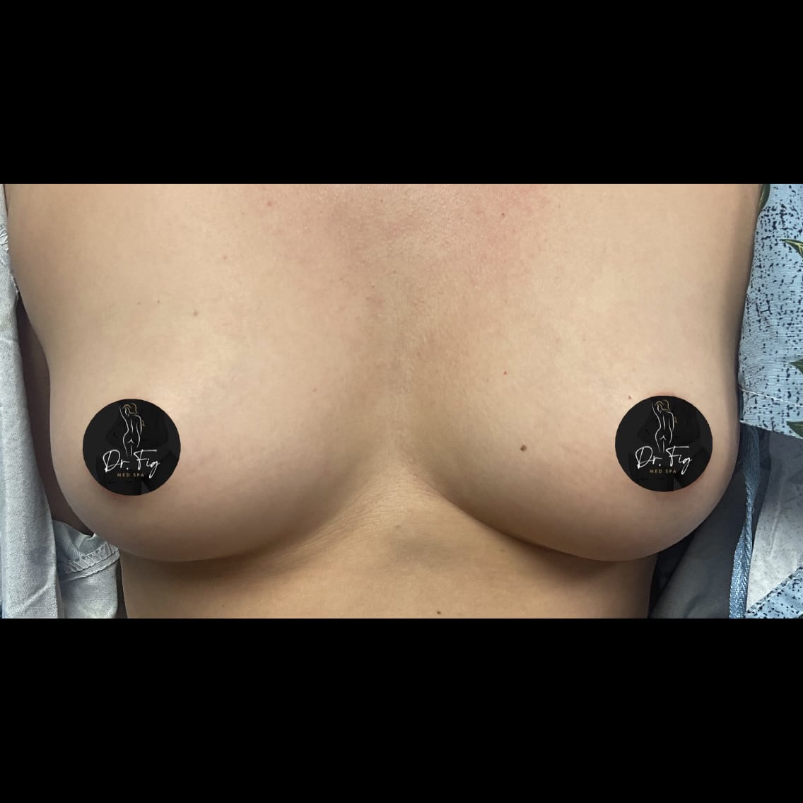 Before Image: Breast Augmentation - front