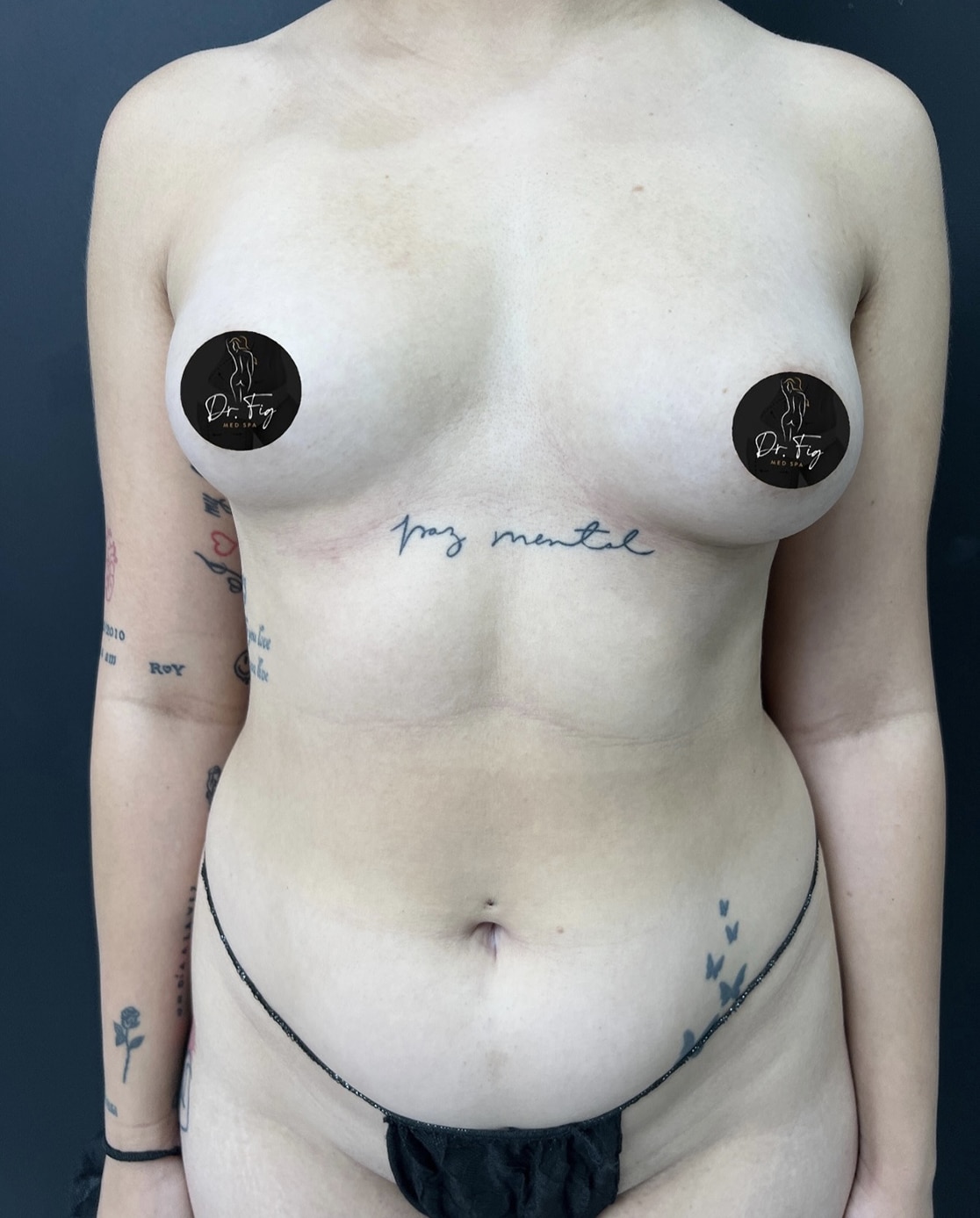 Before Image: Breast Augmentation, Lipo 360, BBL - front