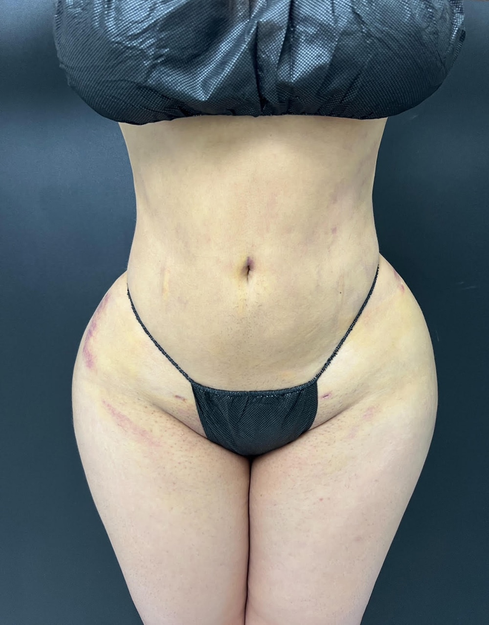 After Image: Liposuction 360 - front