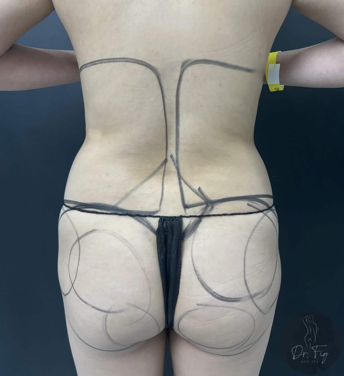 Before Image: BBL - back