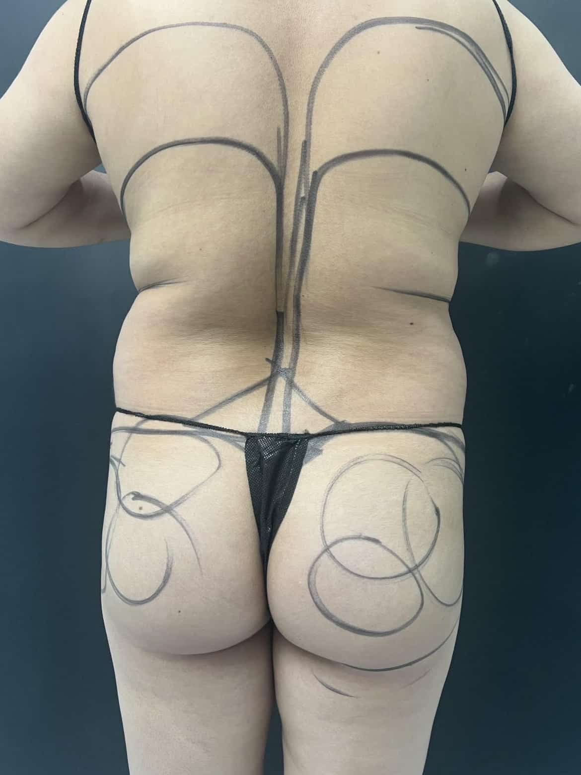 Before Image: Lipo 360, BBL - back