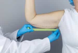 Older woman pointing to dangling skin near her elbow during a consultation, highlighting problem areas for brachioplasty or arm lift before cosmetic surgery.