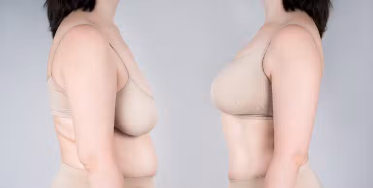 Before-and-after results of a woman's breast lift surgery after pregnancy, showcasing restored shape and firmness against a gray background