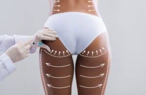 Young woman in white bikini receiving injection in hip area for Brazilian Butt Lift procedure, highlighting body contouring and aesthetic enhancement.