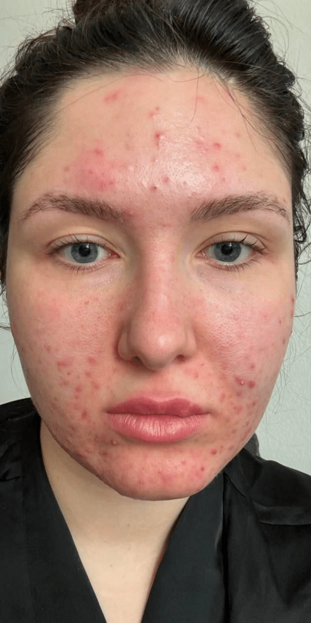 Before Image: Facial - front