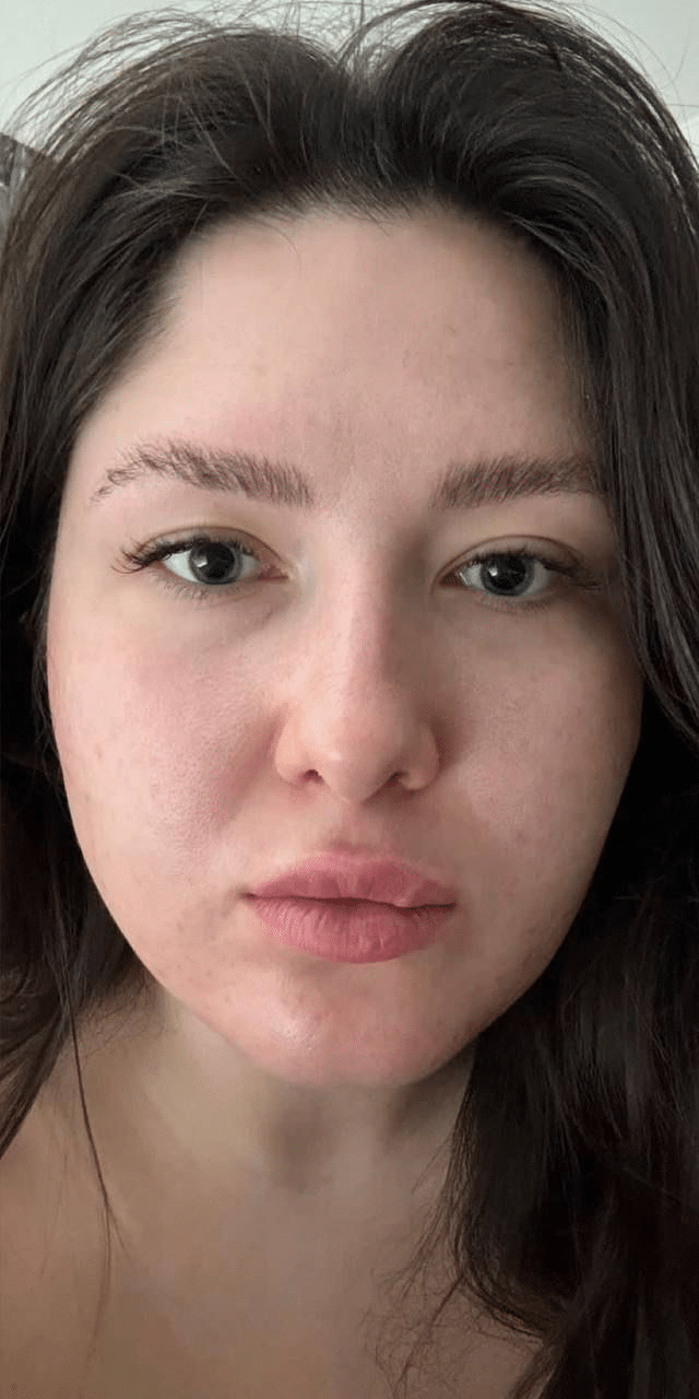 After Image: Facial - front