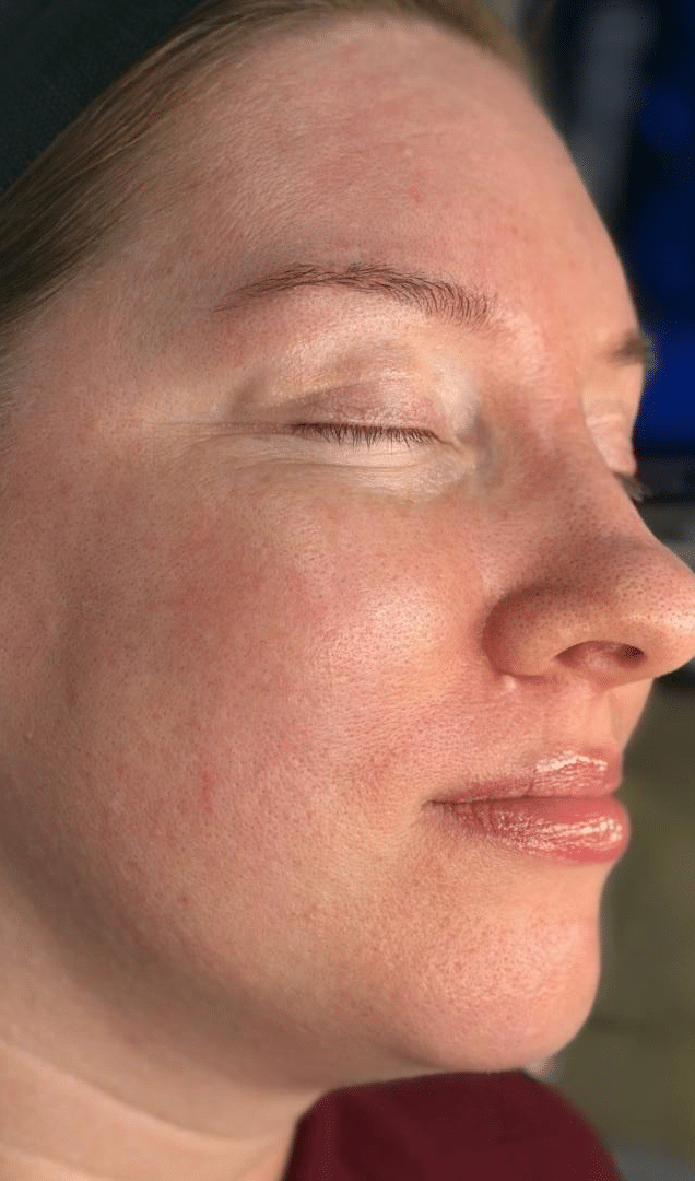 After Image: Facial - right-front-oblique