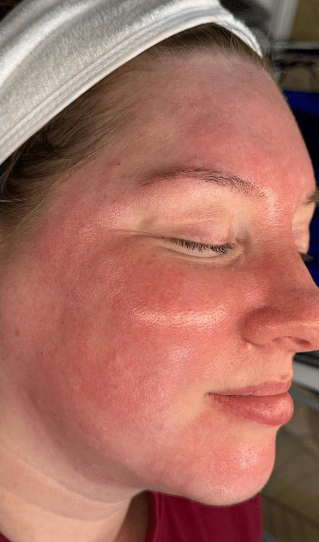 Before Image: Facial - right-front-oblique