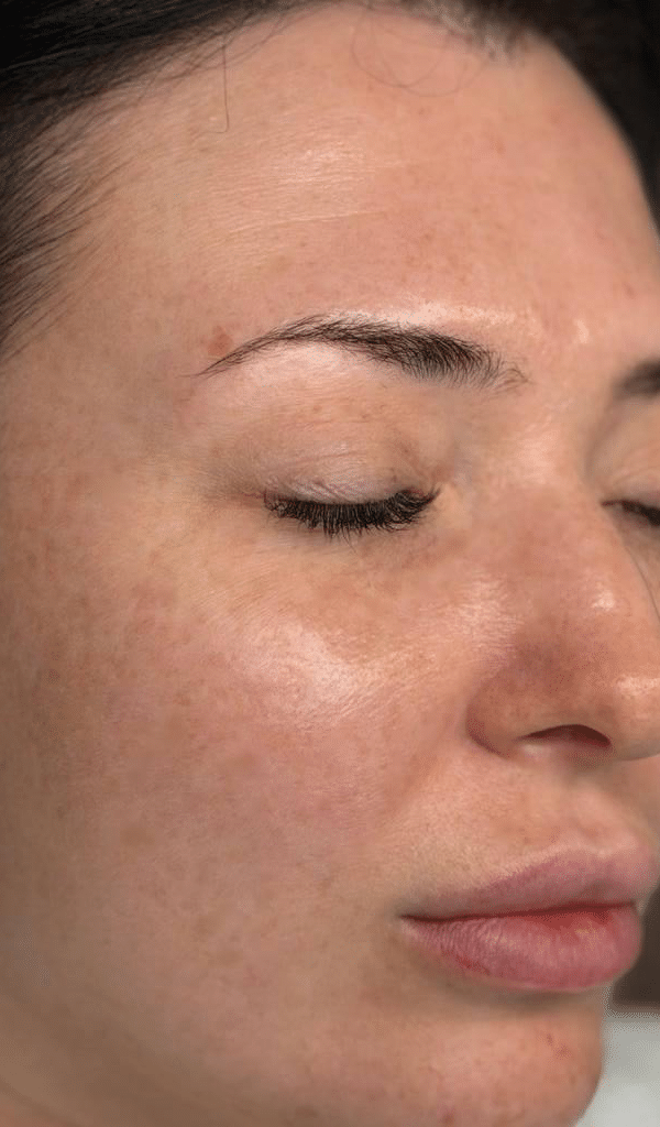 After Image: Facial - right-front-oblique