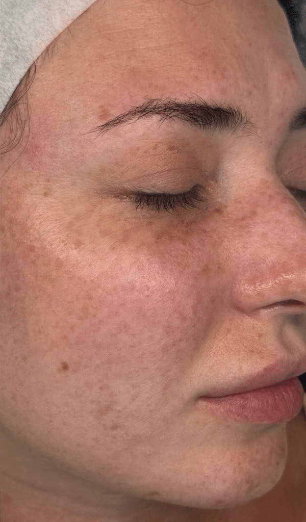 Before Image: Facial - right-front-oblique