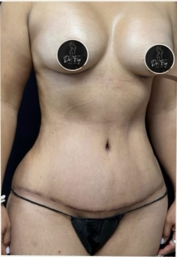 After Image: Breast Augmentation and Tummy Tuck - front