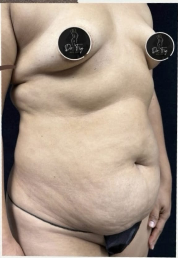 Before Image: Breast Augmentation and Tummy Tuck - front