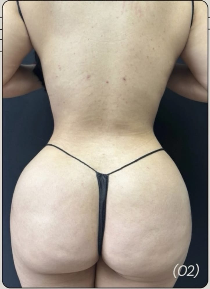 After Image: Lipo 360, BBL - front