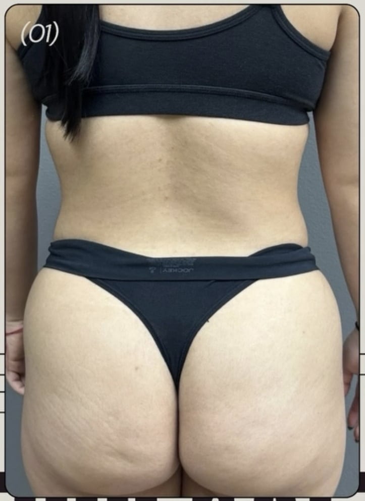 Before Image: Lipo 360, BBL - front