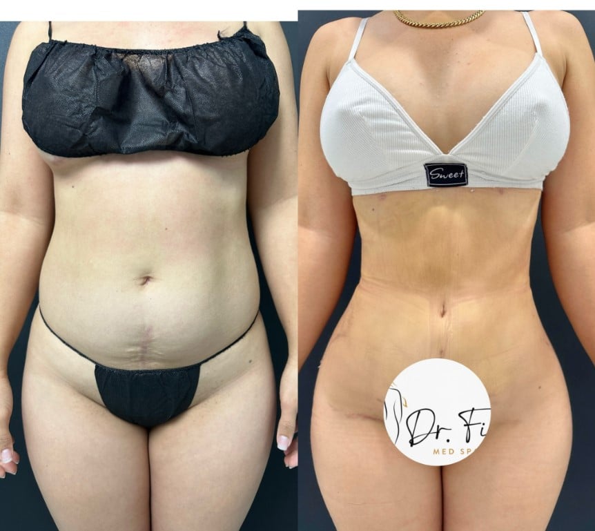 Weight Loss (Semaglutide) in Tampa, FL