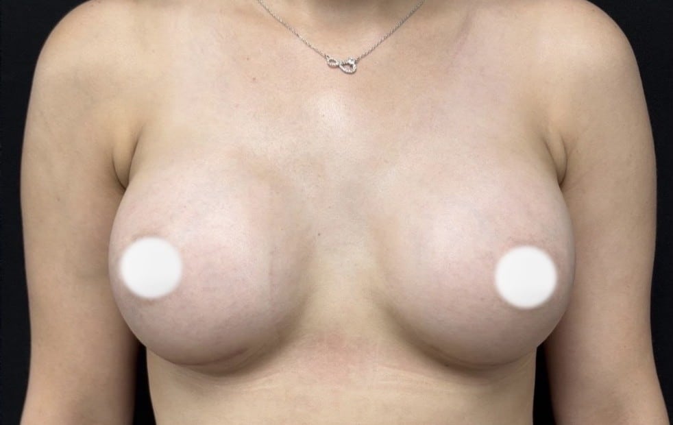 After Image: Breast Augmentation - front