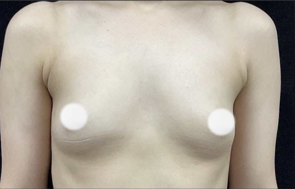 Before Image: Breast Augmentation - front