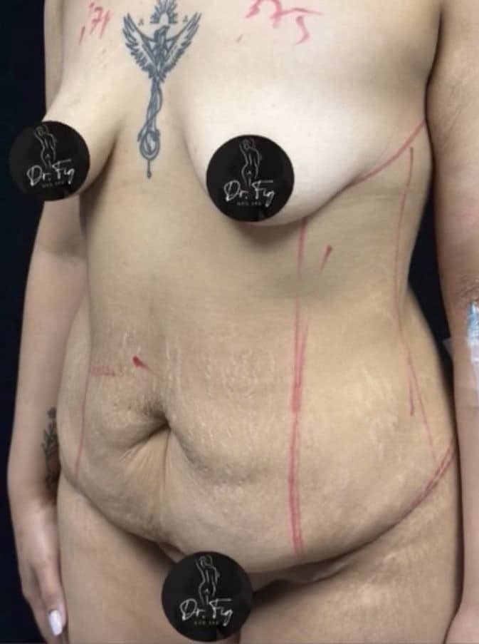 Before Image: Breast Augmentation and Tummy Tuck - front